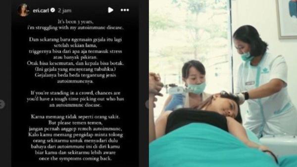 Erika Carlina curhat idap autoimun