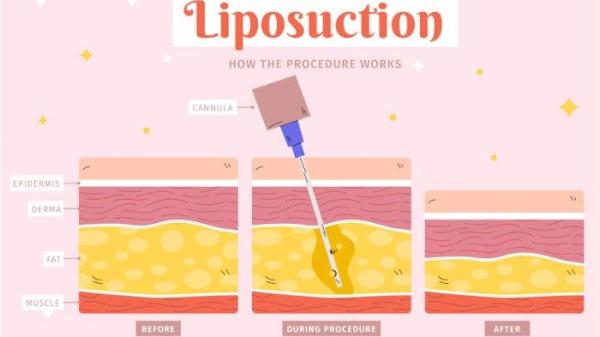 Ilustrasi operasi sedot lemak