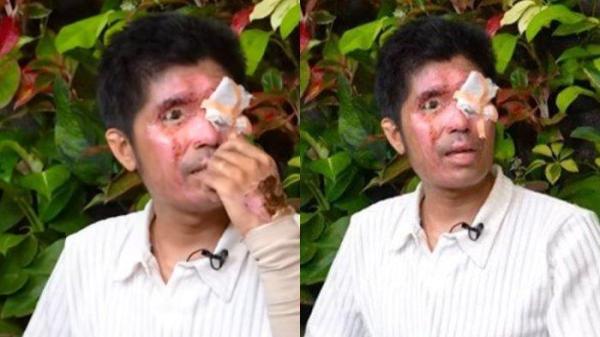 PILU Pengakuan Agus Salim Wajah Disiram Air Keras, Pelaku Sakit Hati Ditegur, Kini Mata Korban Buta