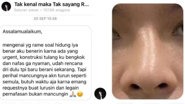 Potret bentuk hidung Rey Mbayang sebelum jalani oplas