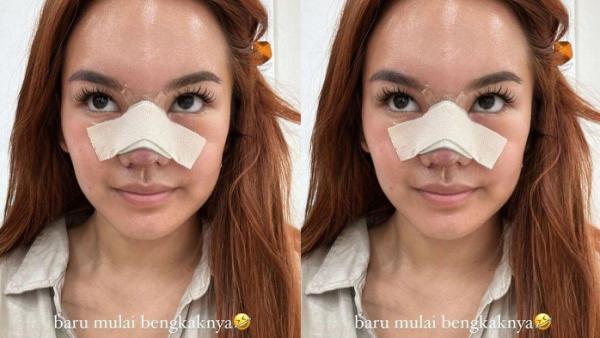 Wajah Shafa Harris mulai bengkak usai oplas