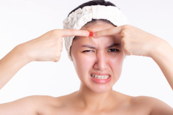 Ilustrasi acne prone skin. Foto: Shutter Stock