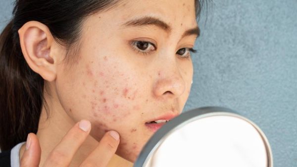 Ilustrasi acne prone skin. Foto: Boyloso/Shutterstock