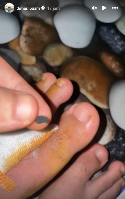 Kondisi kaki Dimas Ahmad.