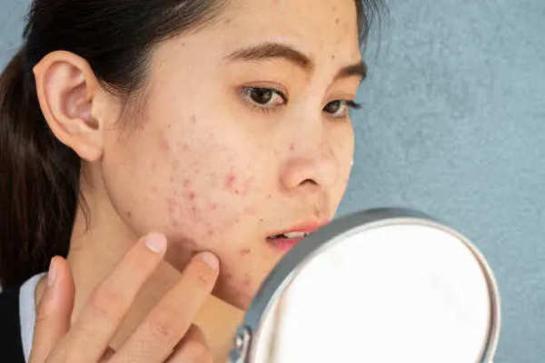 Acne problem