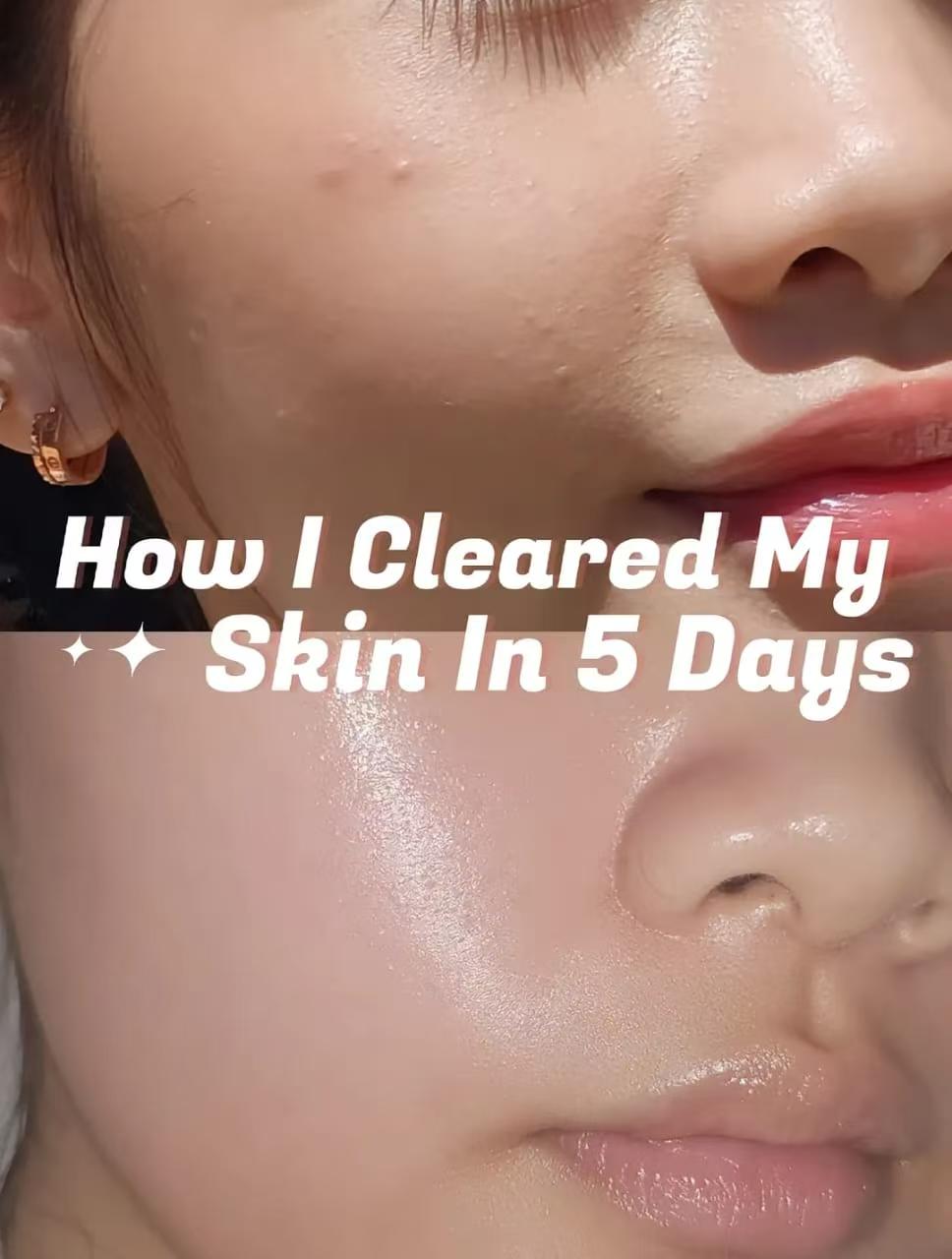 Clear Skin In 5 Days!