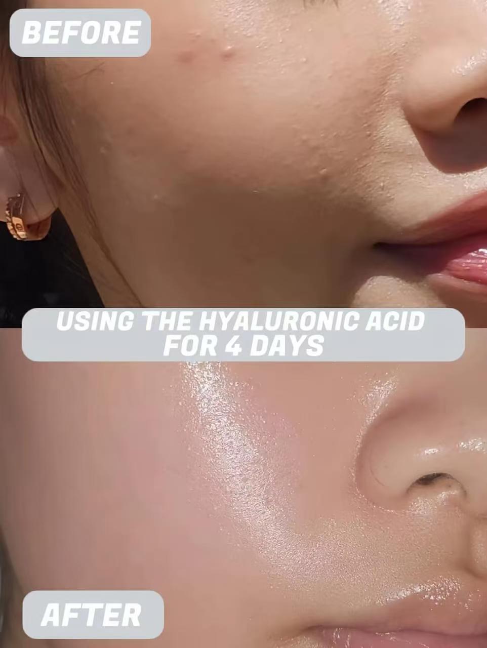 Clear Skin In 5 Days!