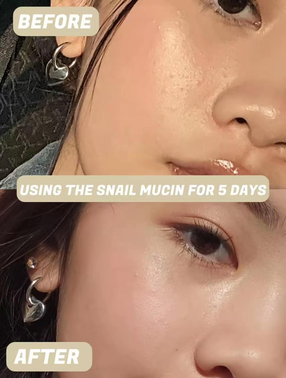 Clear Skin In 5 Days!
