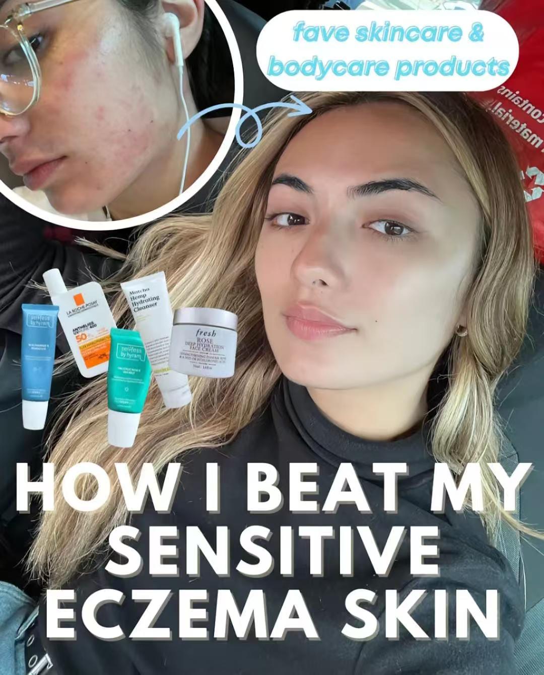 Eczema? Read This!