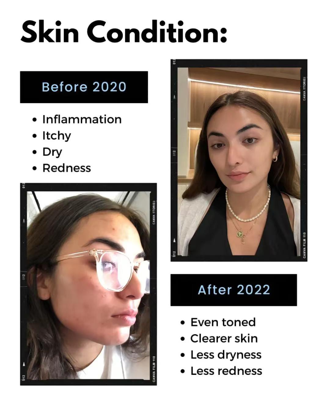 Eczema? Read This!
