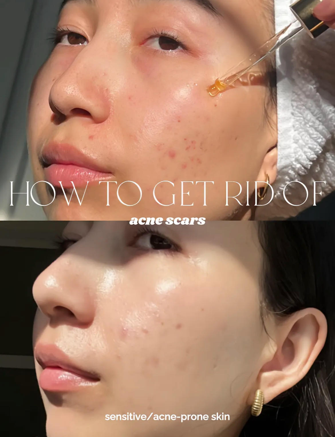 Clearer Skin Ahead!