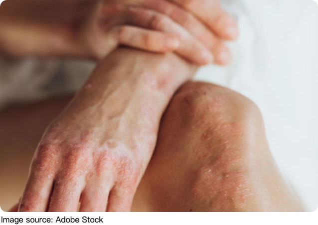Tremor Vs Parkinson Disease