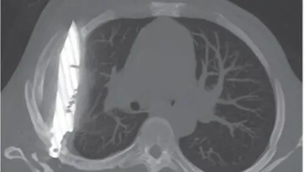 Penampakan pisau menancap di dada pasien pria.