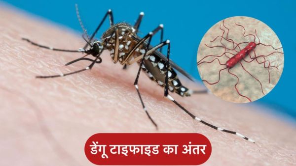 Dengue and Typhoid Symptoms: What is the difference between dengue and typhoid symptoms? Learn from experts