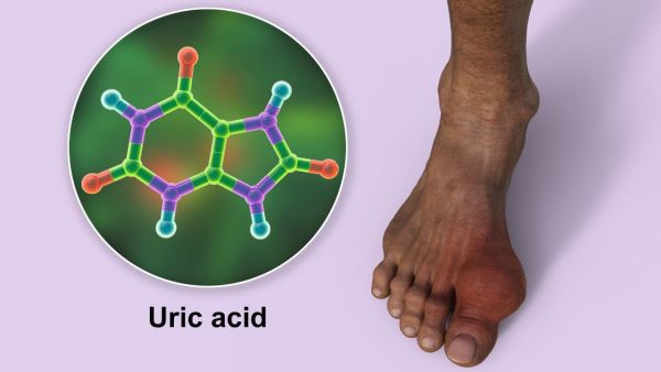 Uric Acid: What symptoms are seen when uric acid increases? How to control?