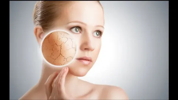 Close-up of severely dry and cracked skin on a hand or heel.