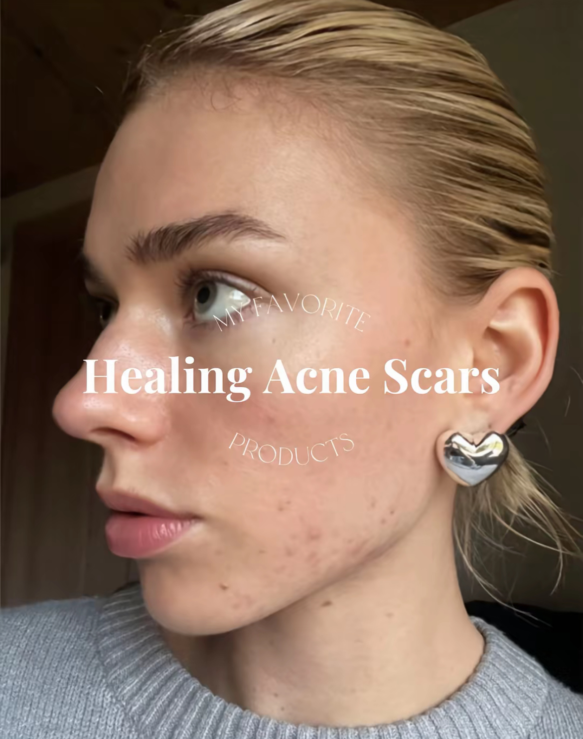 Acne Scar Fixers!