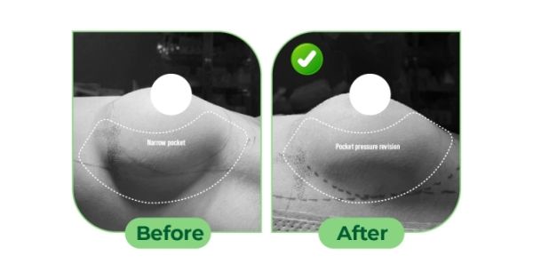 After assessing the current situation, Dr. Vu used an ultrasound knife to reshape the pocket to fit the new breast implant. Photo courtesy of Dr. Cao Vu