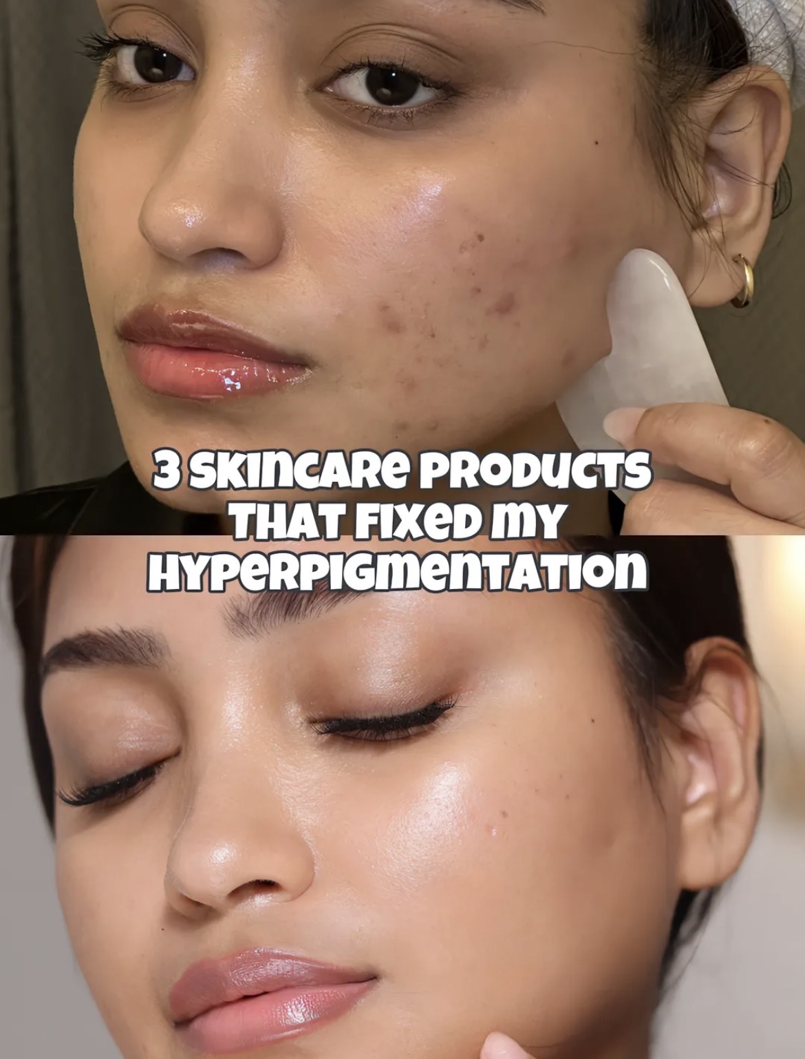 Hyperpigmentation Gone!