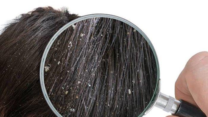 Ilustrasi dijumpai ketombe