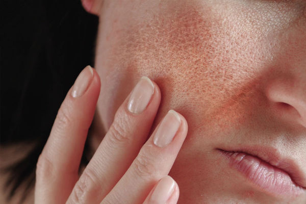 Ichthyosis Vulgaris ची लक्षणे आणि उपचार जाणून घ्या