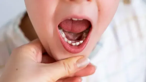 baby showing his teeth with cavities