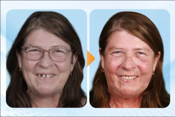 Samantha after implant treatment at Dr. Care, receiving digital dental impressions and internationally certified porcelain restorations, achieving excellent aesthetic and functional results with a shorter time to her new smile. Photo courtesy of Dr. Care