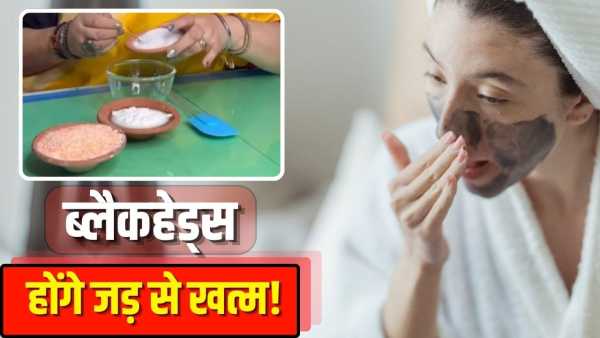 No need for expensive treatment! You will get rid of blackheads and whiteheads, just apply these 3 things
