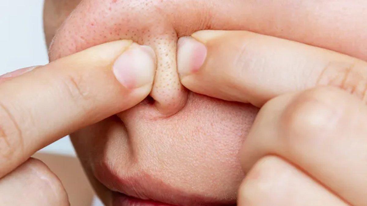 Ilustrasi area hidung yang mengalami masalah komedo akibat tidak menggunakan sunscreen