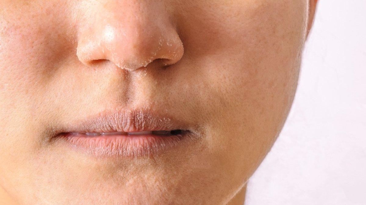 Ilustrasi kulit wajah kasar akibat tidak menggunakan sunscreen