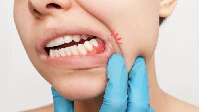 ilustrasi seseorang yang mengalami gingivitis atau radang gusi