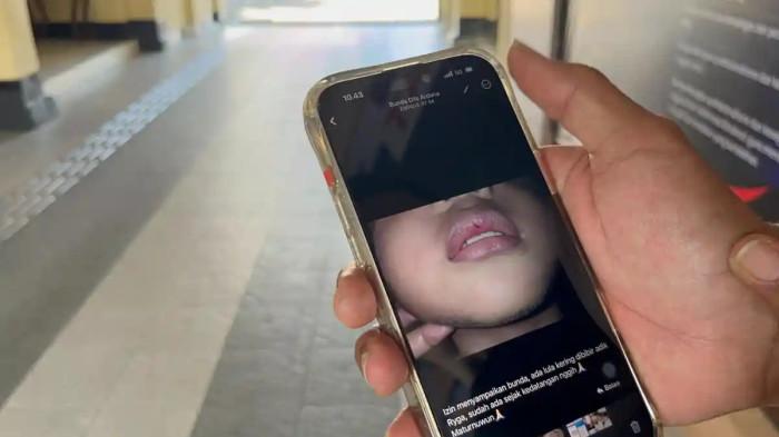 LUKA DI BIBIR - Foto anak yang mengalami luka di bibir akibat dugaan kekerasan di daycare bernama Little Aresha wilayah Umbulharjo, Kota Yogyakarta. Korban cerita ke ibunya soal yang dialaminya selama dititipkan