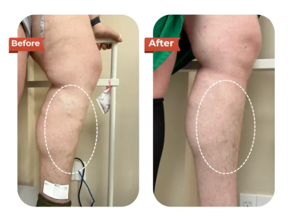 The patients left leg before (L) and after (R) treatment. Photo courtesy of Dr.Vein